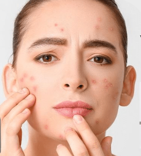 Spot Solutions for Acne & Pimples in Pakistan (2026 Complete Guide)