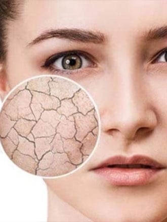 Dryness-and-Dehydration