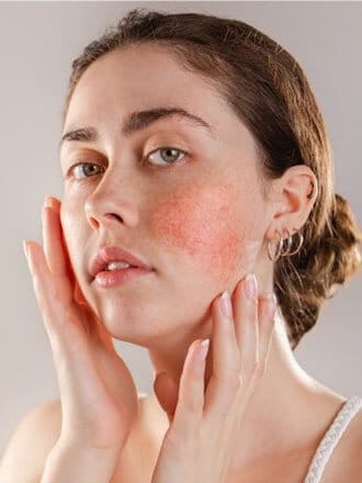 Look of Redness