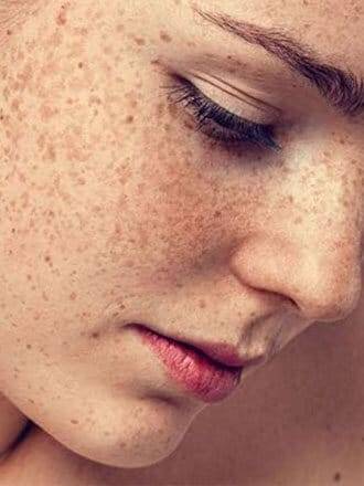 Melasma