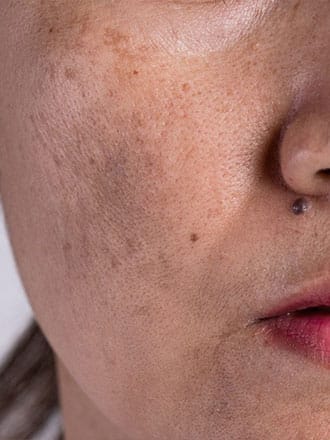 Pigmentation